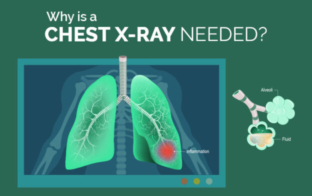 Avail Trusted Chest X Ray in Budget Cost in Kolkata - Accuhealth ...